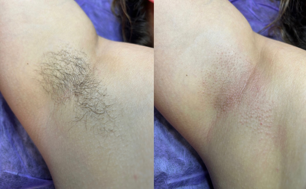 Underarm Wax