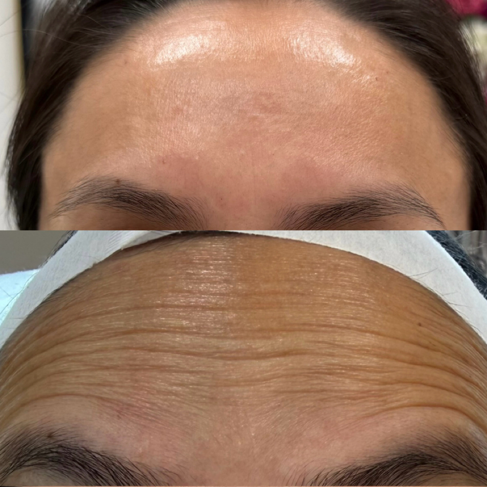 Neurotoxins (Botulinum at Estediva Aesthetics in Long Island City, NY