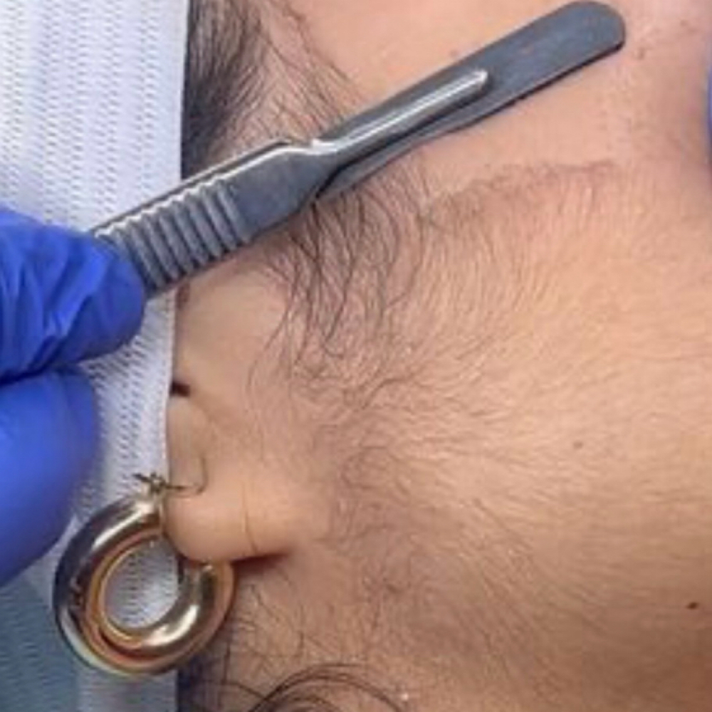 Dermaplane at Skin Is In Esthetics in Sarasota, FL