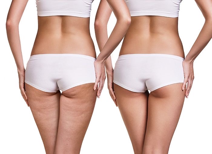 Noninvasive Brazilian Butt Lift