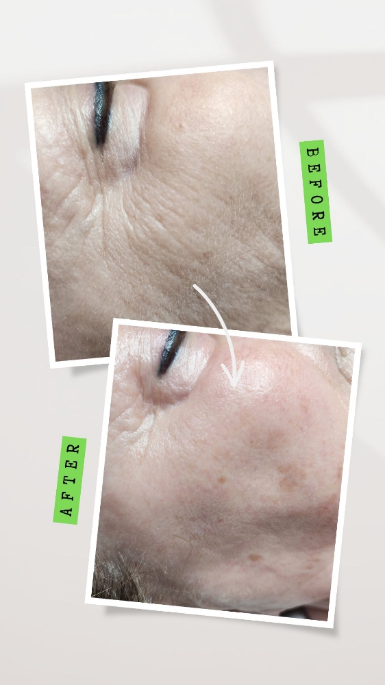 Dermaplaning