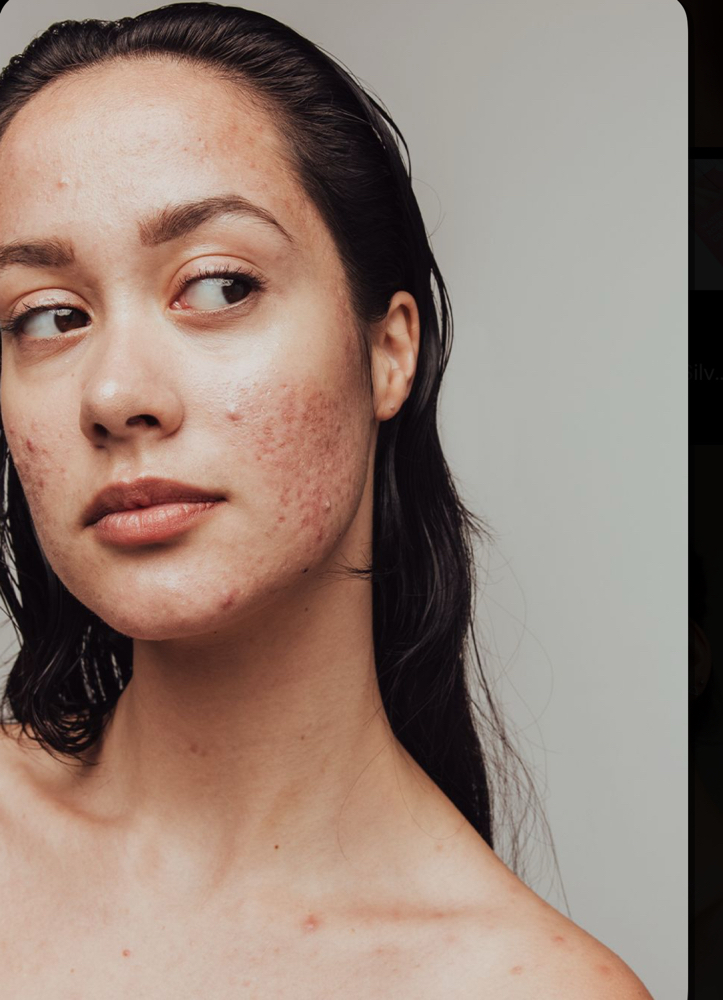 European Detox Acne Facial