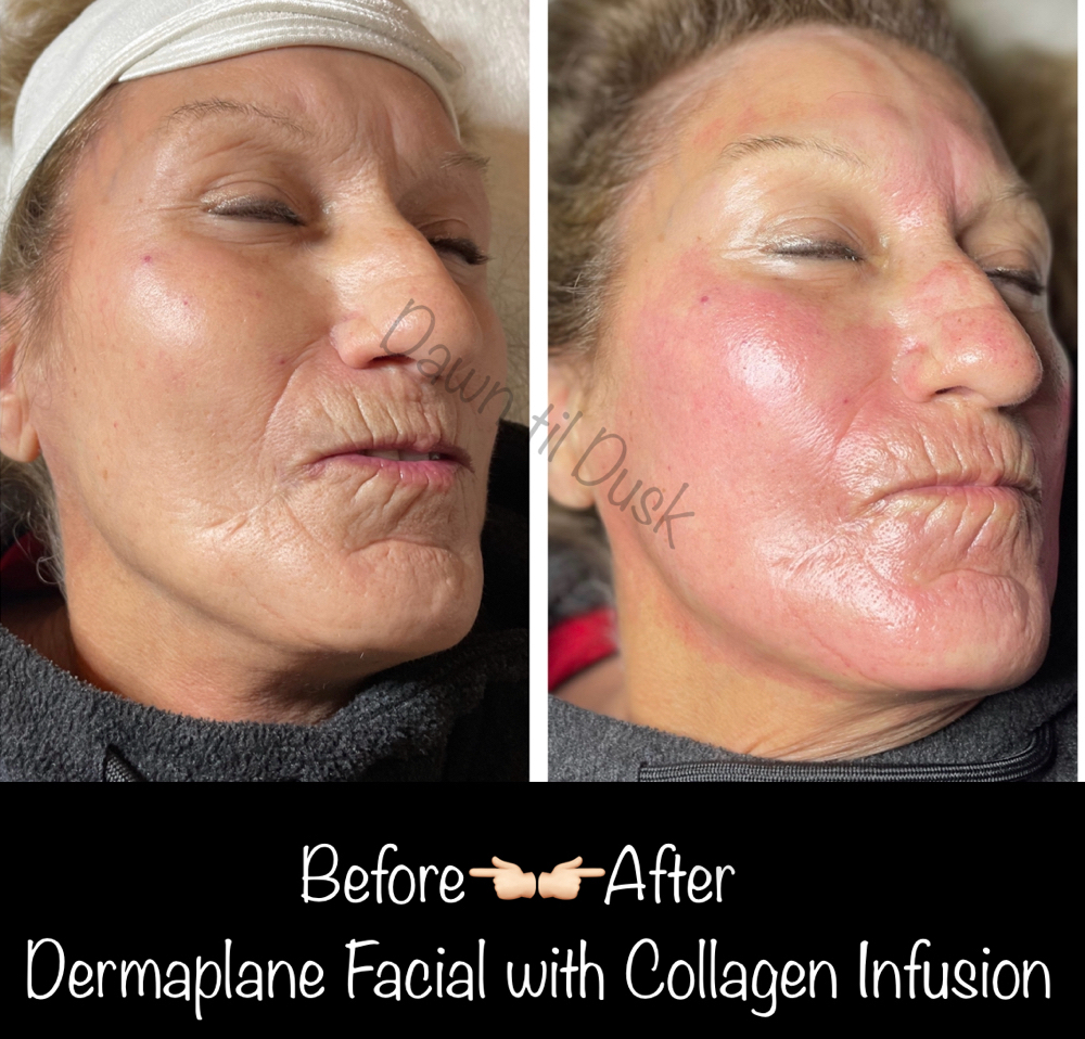 Dermaplaning Facial
