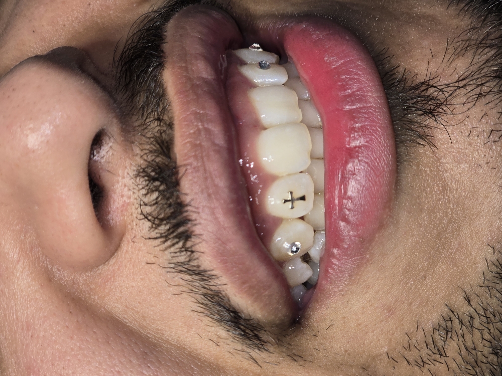 Tooth gems