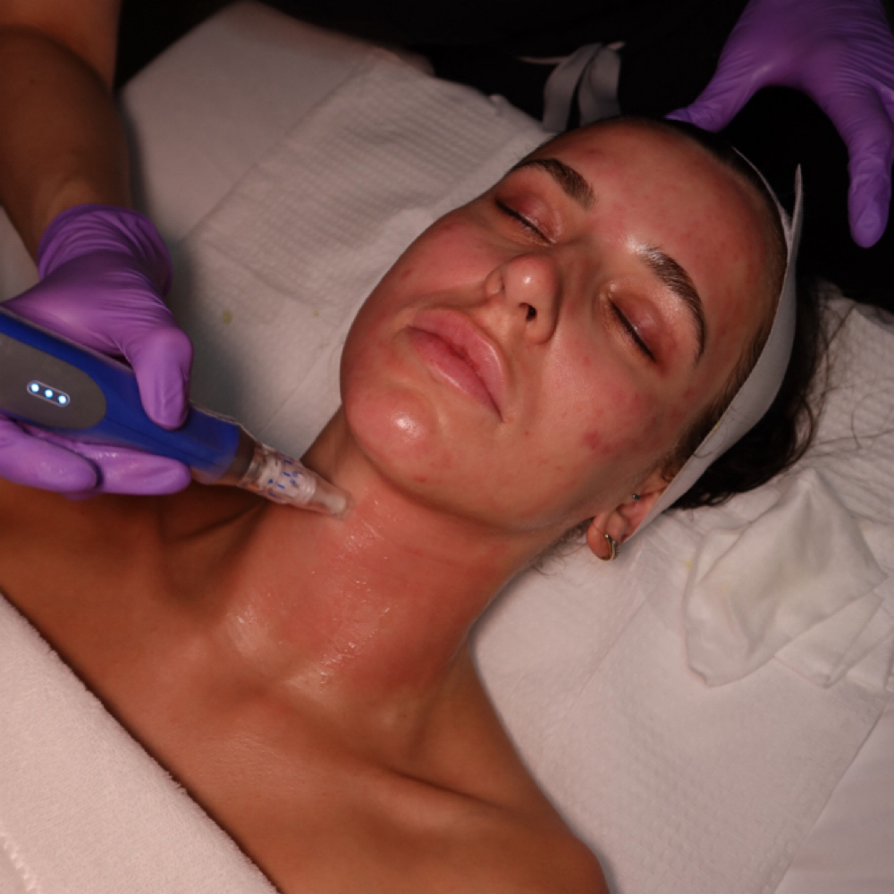 SkinPen Face & Neck at Lumis MedSpa in Houston, TX