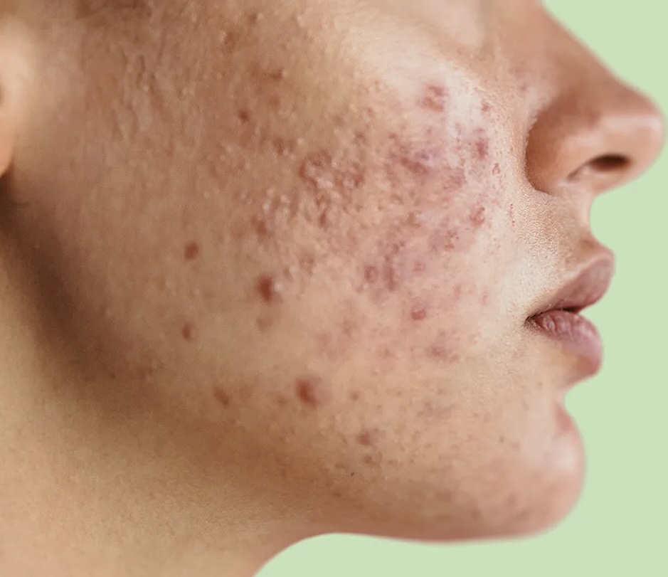 Acne Treatment