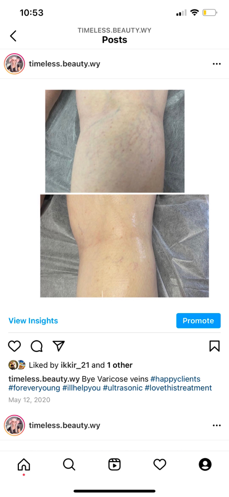 Varicose vein removal