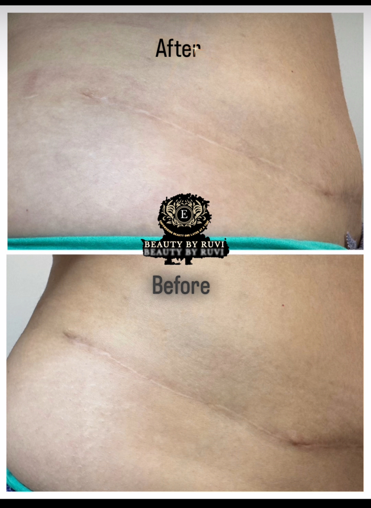 Paramedical Tattooing Large Area