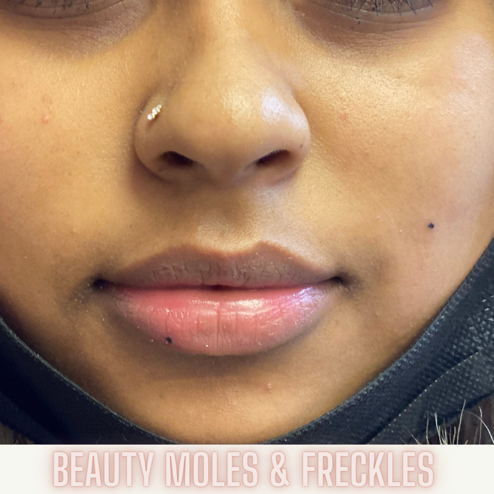 Beauty Moles/Freckles
