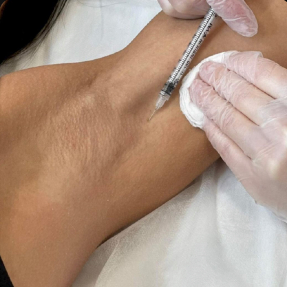 Hyperhidrosis Armpit Treatmeant at Adrienne Hope’s Aesthetics in Englewood, CO