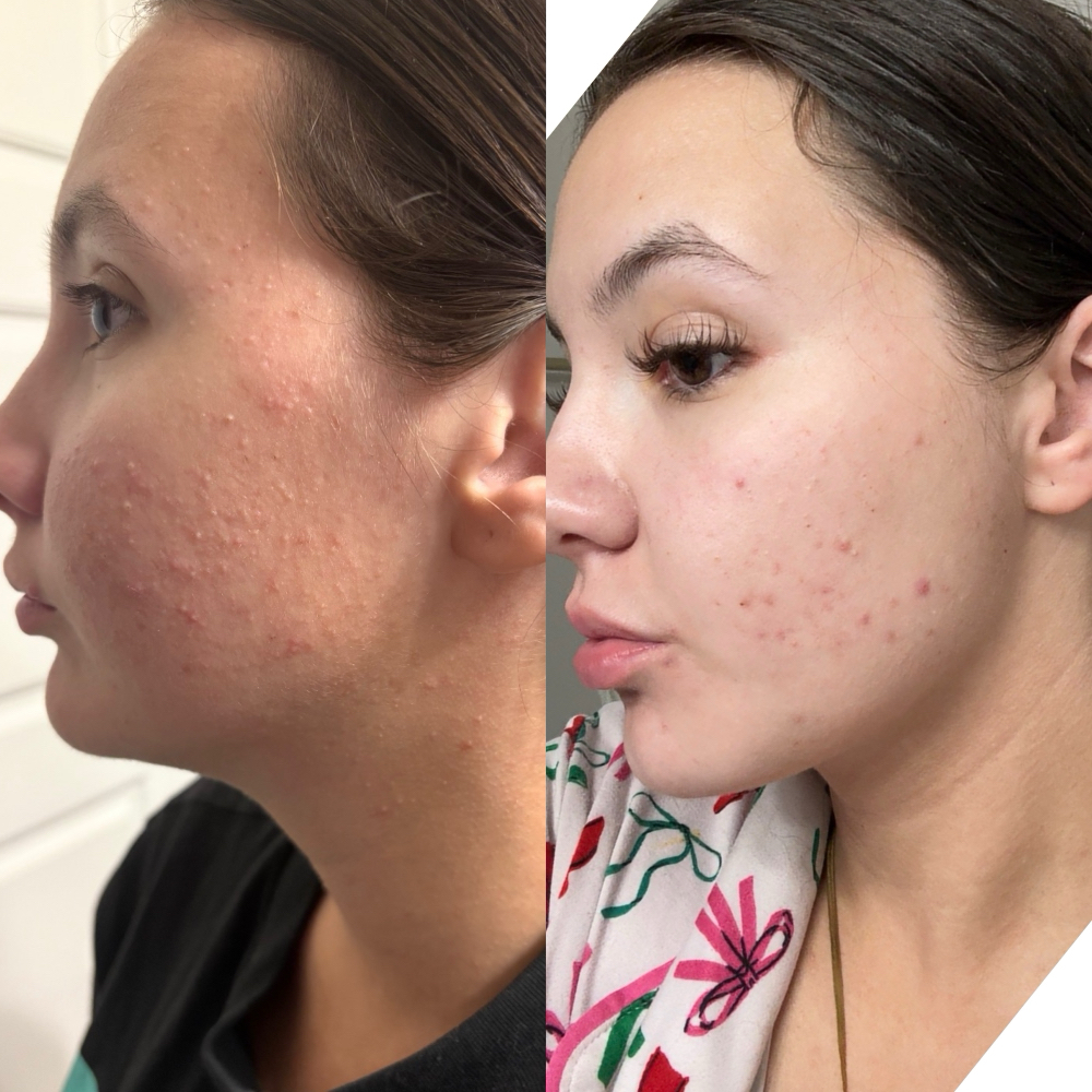 In-Depth Acne Consultation at Native Complexions in Winchester, KY