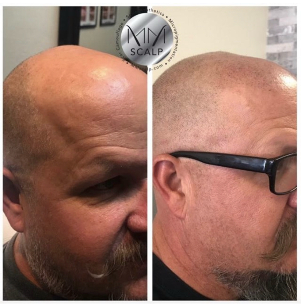 Scalp Micropigmentation By Tamara