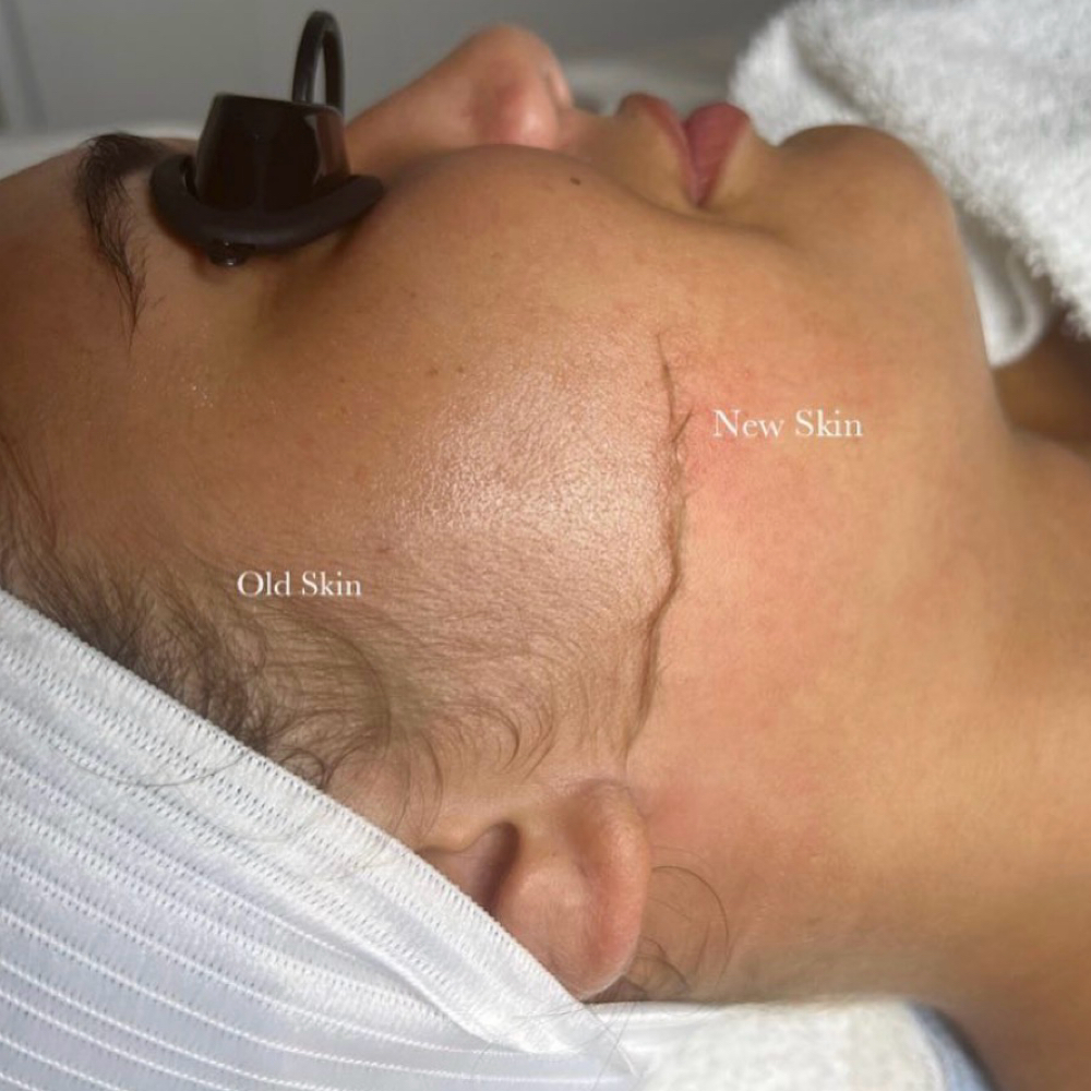 Get Glowing Dermaplaning Facial at Skin Alchemy in South Charleston, WV