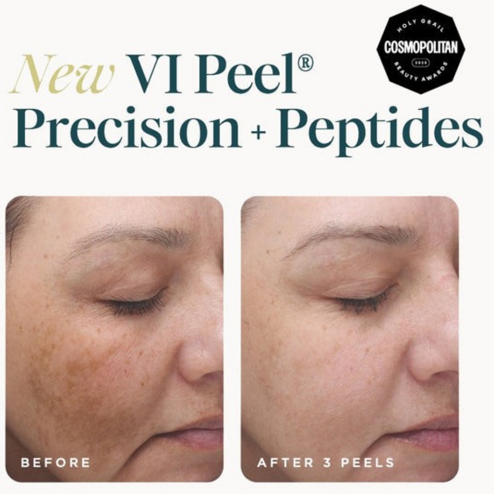 VI Peel at Injections Aesthetics By Lisa in San Antonio, TX