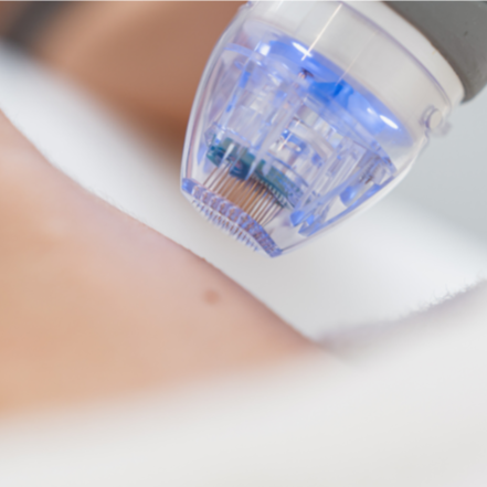 Microneedling at DM Laser Skin Care Solutions in Needham, MA