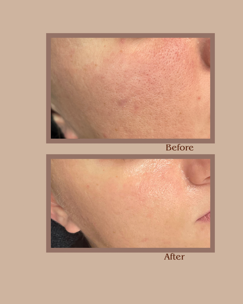 Chemical Peel 3 Pack