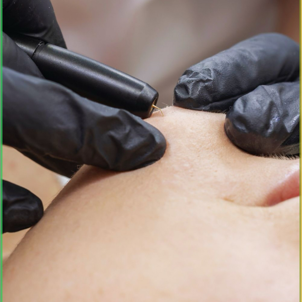 Consultation + 15 Min Treatment at Ama Aesthetics Studio in Methuen, MA