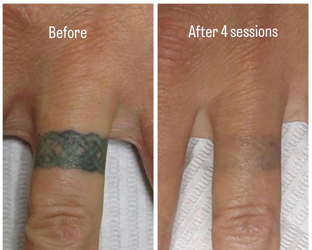 Tattoo Saline Removal