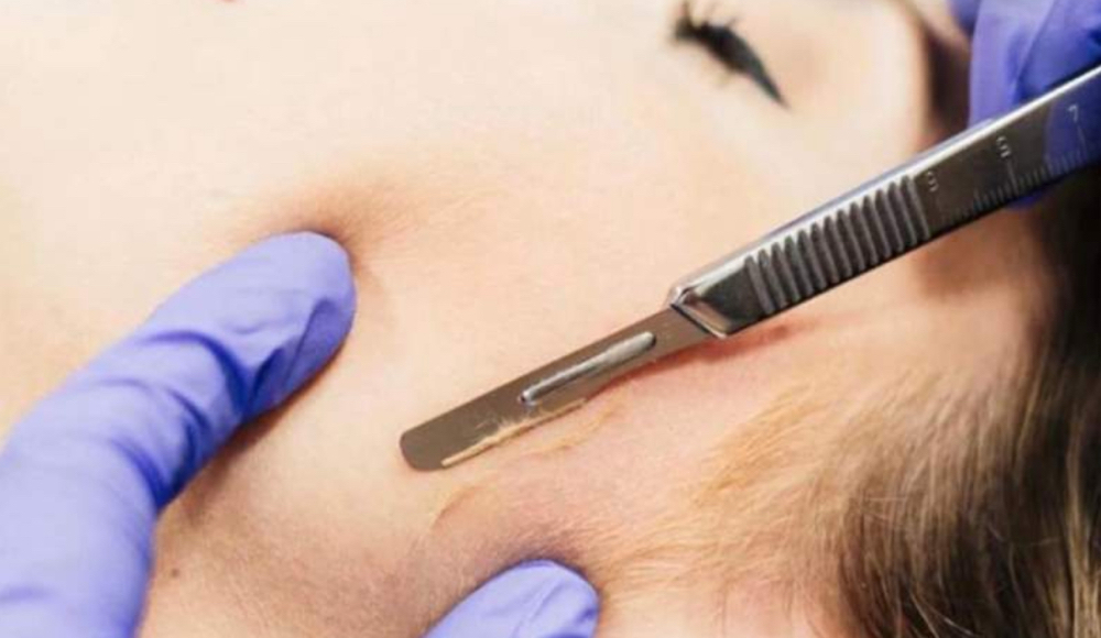 Dermaplaning (ADD ON)