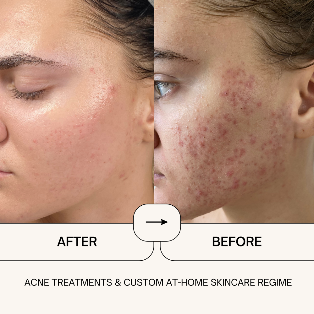 Chemical Peel Treatment