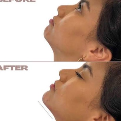 Chin Filler at Ultimate Health Spa in Leesburg, FL