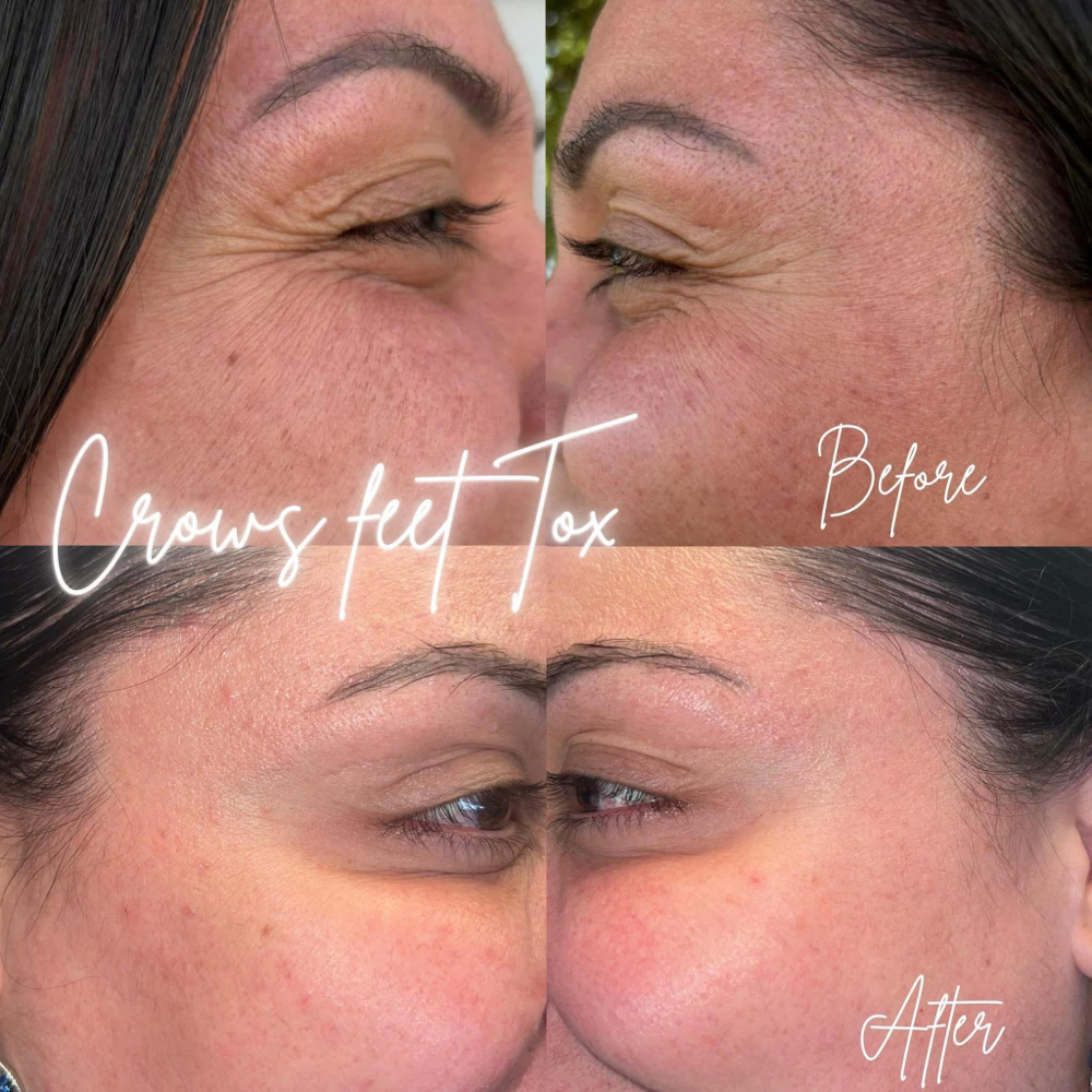 Tox- Crows Feet💉 at BeautyHolic Aesthetics LLC in Lubbock, TX