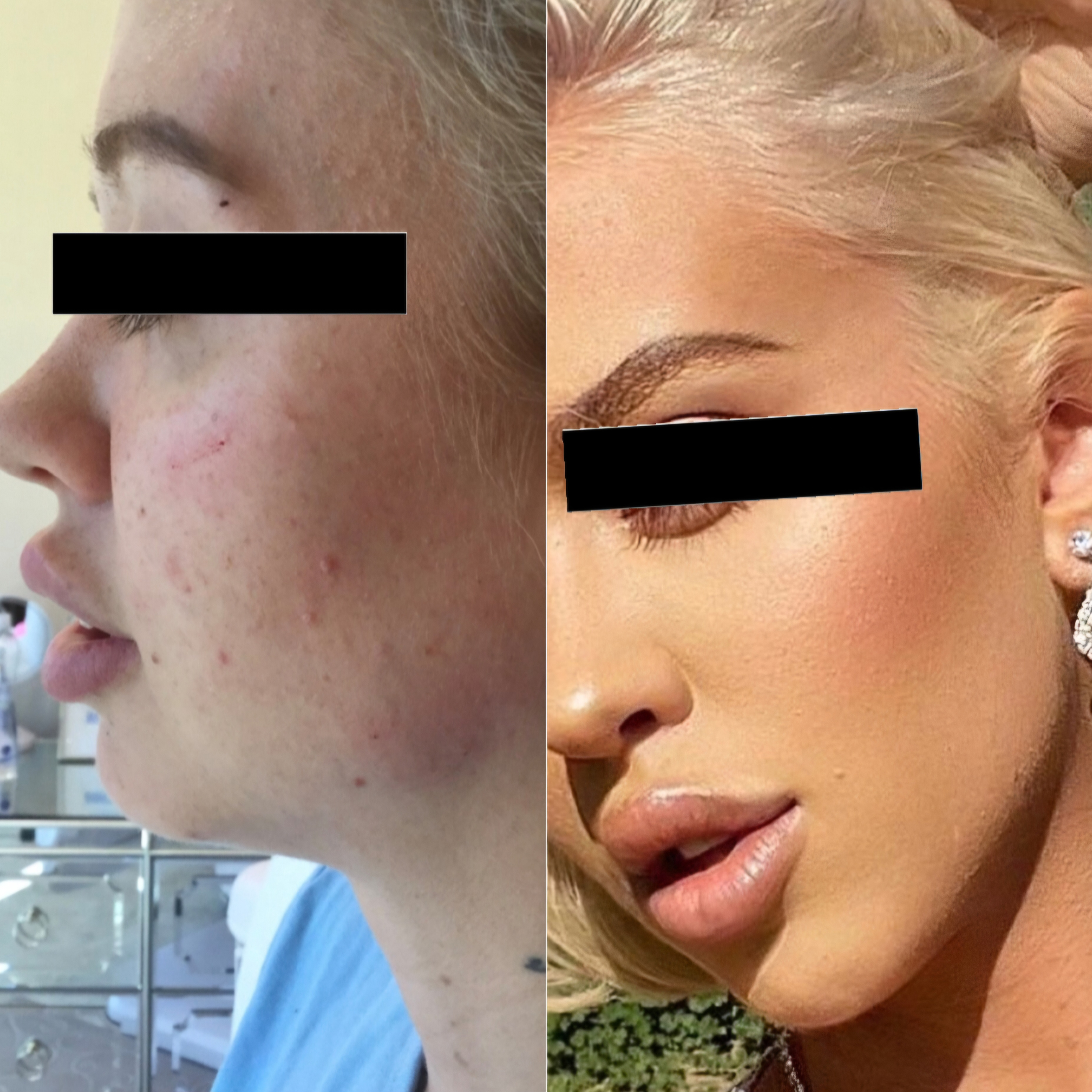 Get Snatched Sesh at Beverly Hills Beauty & Aesthetics in Highlands Ranch, CO