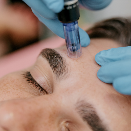 Microneedling + PDRN