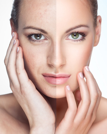 Facial Con Peeling Quimico