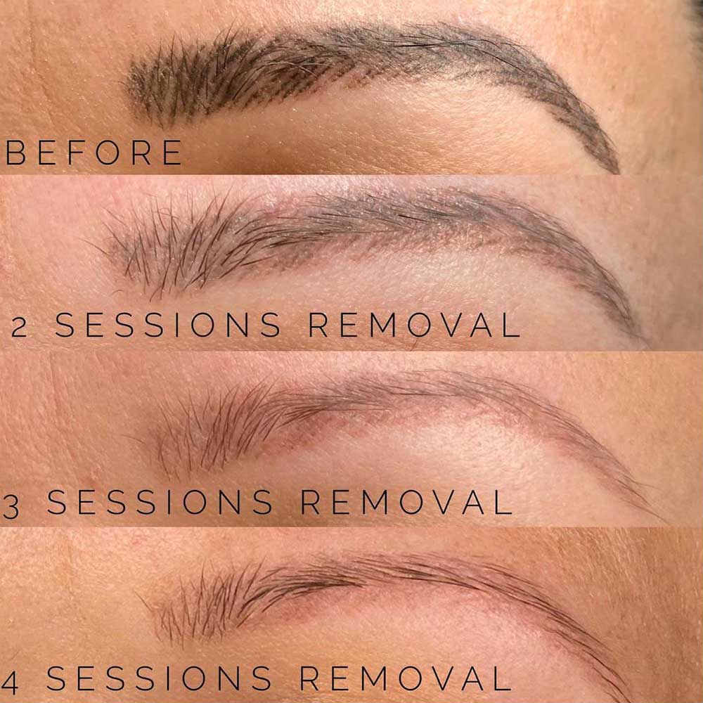 Saline Lightening/ Removal