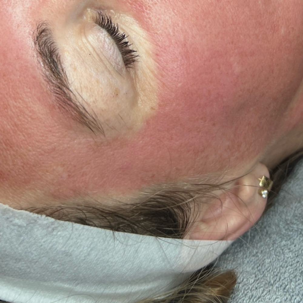 Microneedling (traditional) at Southern Sparkle Medical Aesthetics in Swainsboro, GA