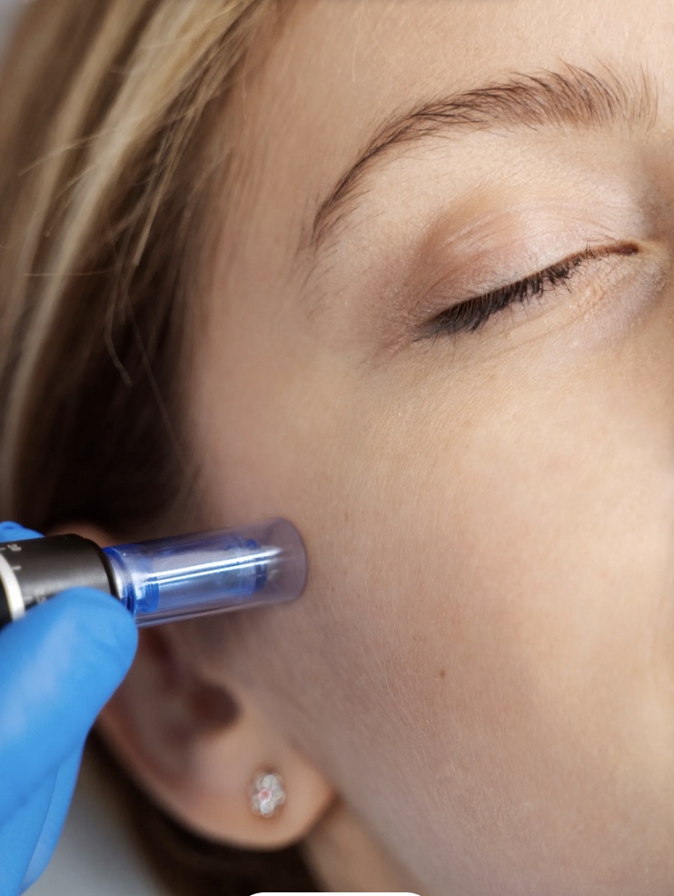 GLOWFACIAL + MICRONEEDLING PEN