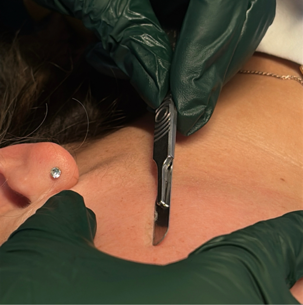 Dermaplane Express at Lasheaskinlab in Worcester, MA