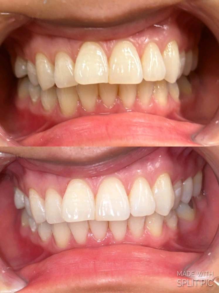 Teeth Whitening 30mins