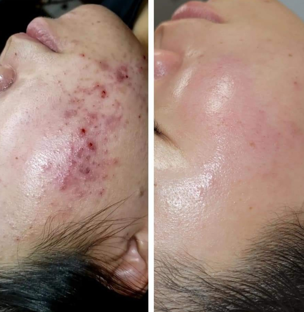 Chemical Peel Series