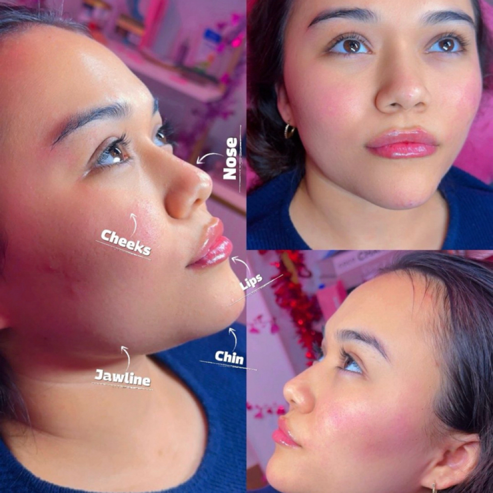 Lip Filler  &  Facial Subscrition at Enhance Aesthetics Medspa in Arlington, TX