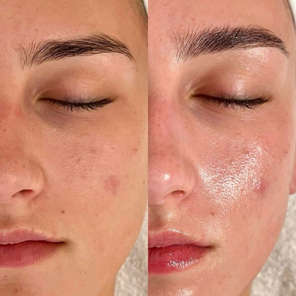 Winter Chemical Peel Facial