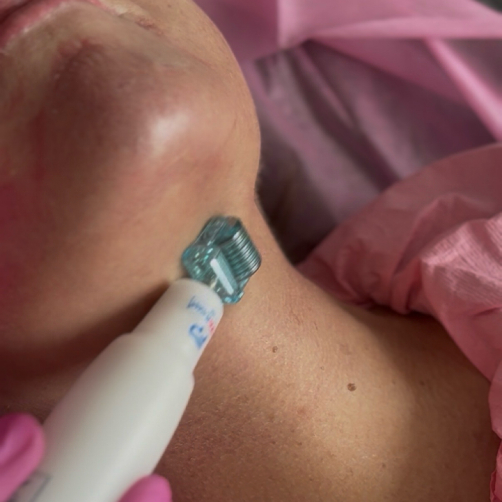 SILVER PLASMA NECK at Beauty and Brows in Queens, NY