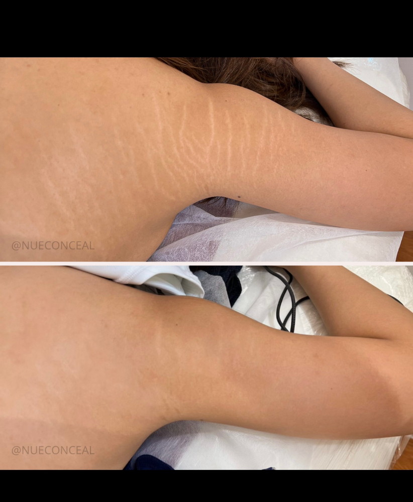 Inkless Stretch Mark Rejuvenation