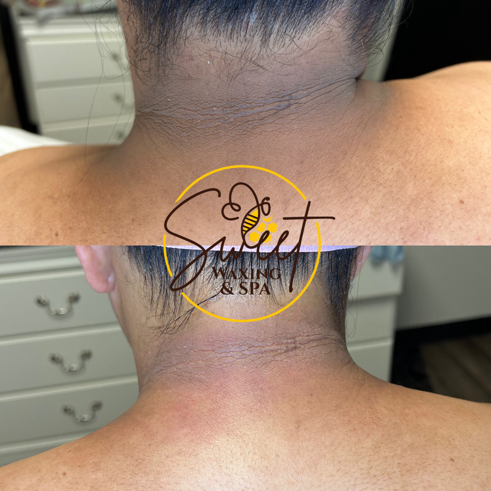 Neck(cuello) Cuello Blanqueamiento