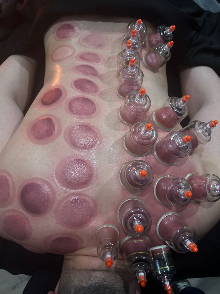 Cupping Add On