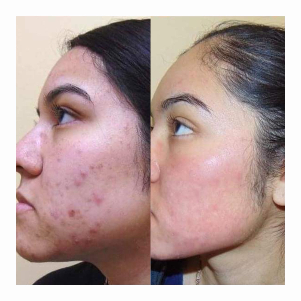 Herbal Natural Face Treatment at Spirit Skin Care in Hallandale Beach, FL