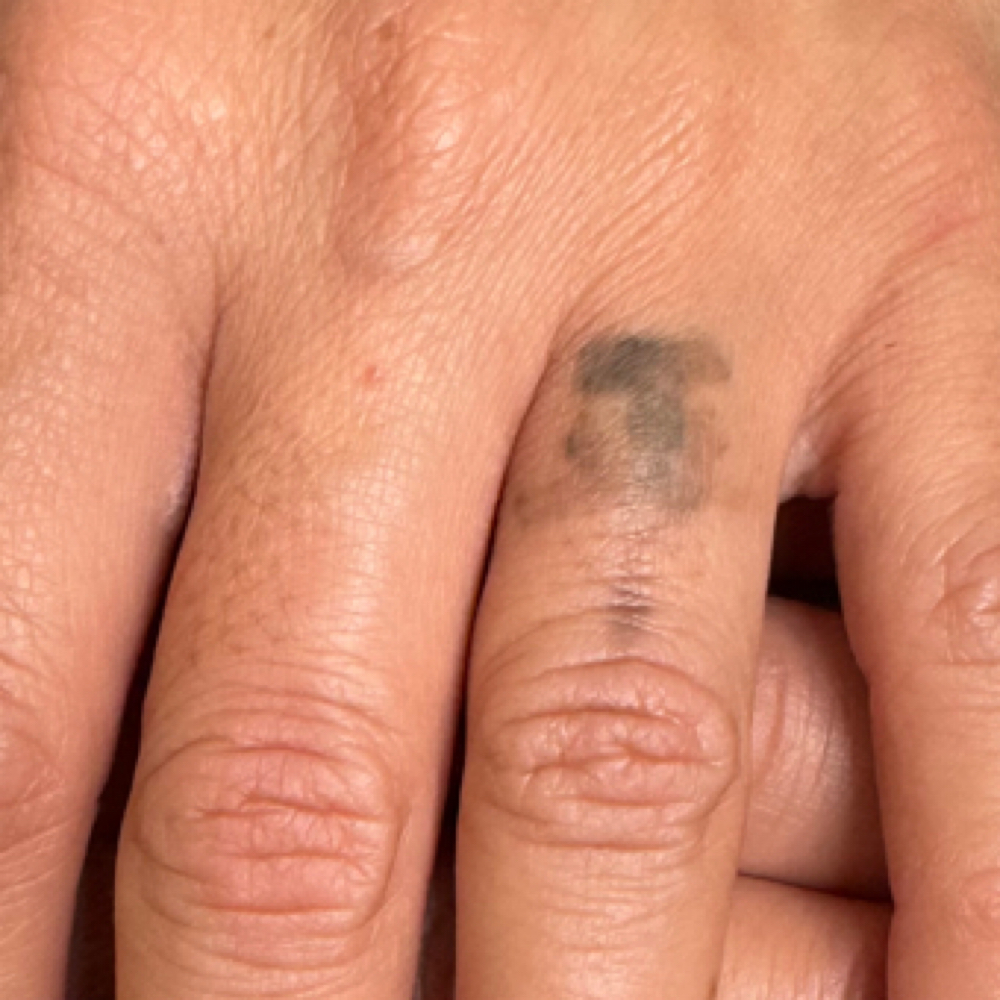 Tattoo Removal at U•Glow by Laura Mesa in Tampa, FL