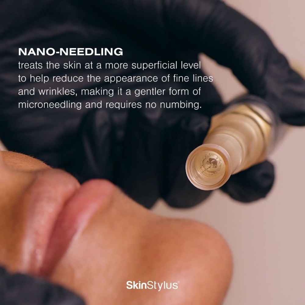 Nano-Needling Treatment at Milagro Beauty Bar in Plymouth, MI
