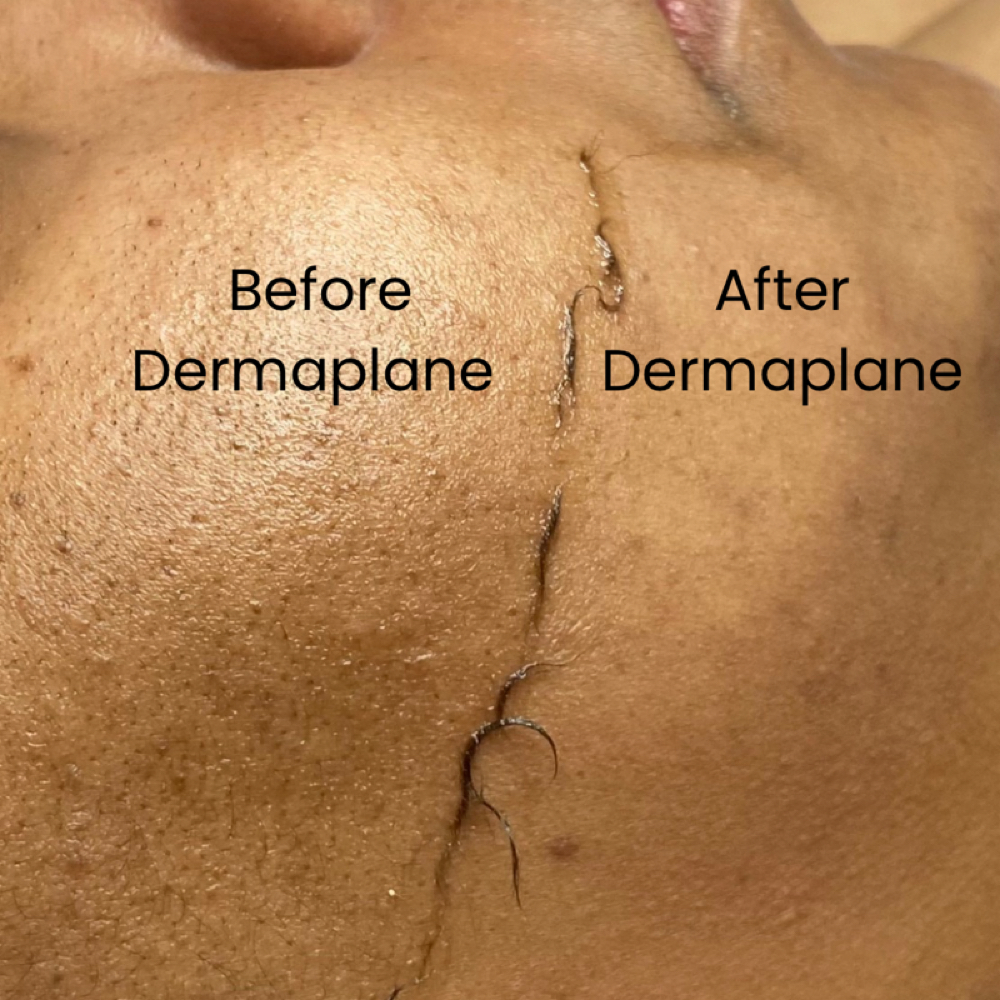 Dermaplane at Volimé Esthetics in Haslett, MI