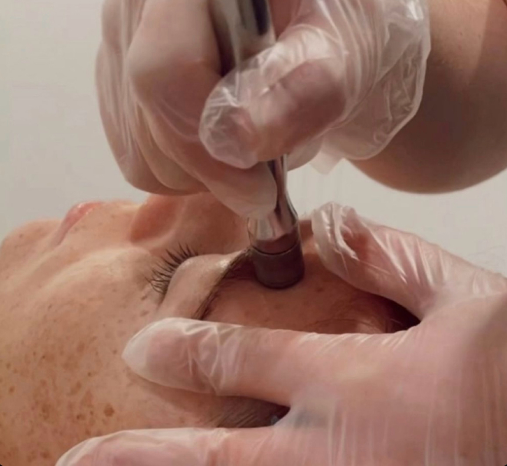 Microdermabrasion at Glow Crazy Esthetics in Saint Joseph, MO