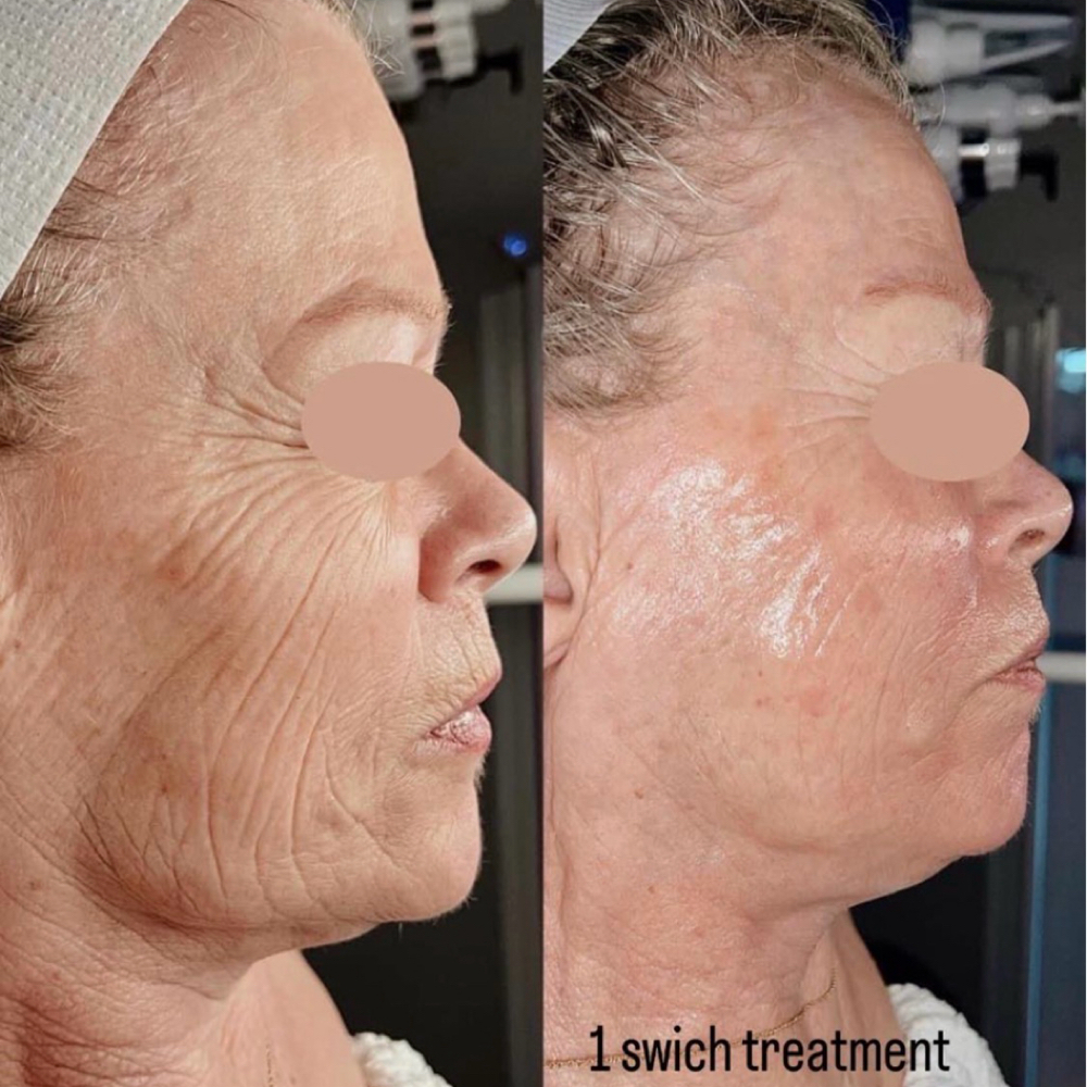 SWiCH Dermal Rejuvenation Treatment at Polished Pearl in Columbus, OH