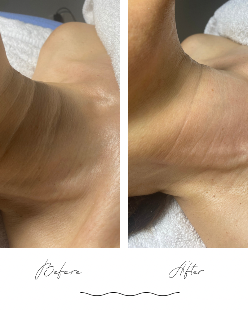 Microneedling at Genie of Skin in Mooresville, NC