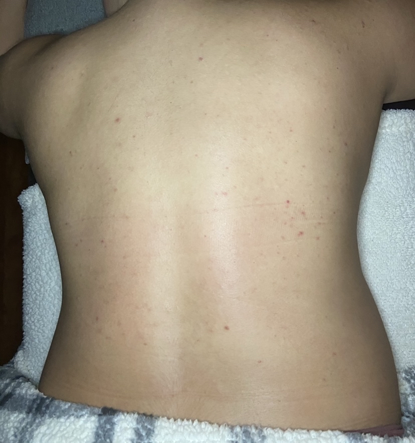 Back Treatment