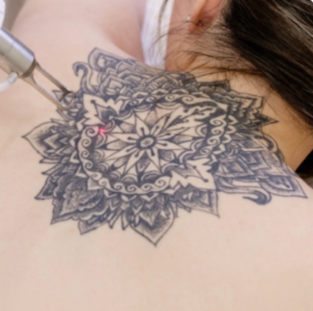 Tattoo Removal LG - Unlimited at NICHÉ in Lewisville, TX